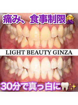 ライトビューティー 銀座店(LightBeauty)/東銀座 ホワイトニング 症例写真