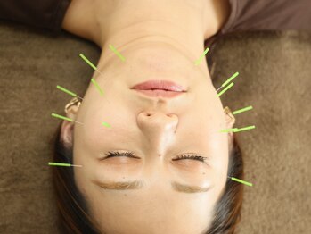 中立売鍼灸整骨院の写真/「ほうれい線やたるみを改善したい」「フェイスラインがコケて見えるようになった」そんな方におすすめ◎