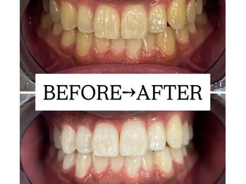 ホワイトニングサロン 宝塚/Before&After美白ホワイトニング