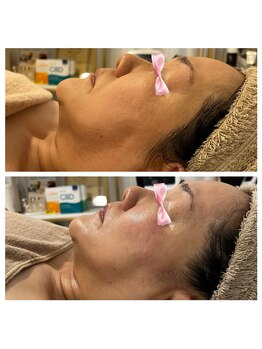 美温(mion)/スキンジェクションプロ