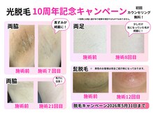クローリス(Chloris)/光脱毛　10年の実績☆