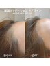 【韓国コンビネーションヘアライン2回】左右 M字 ¥69800→¥59800