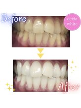 エクシアホワイト 新宿御苑店(ecxia white)/ホワイトニングビフォーアフター