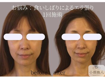 小顔職人/小顔ビフォーアフター/40代