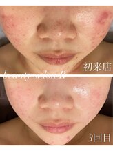 ビューティサロン アール(R)/ニキビといたちごっこから卒業