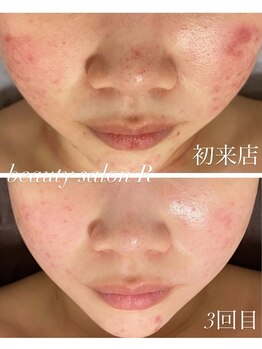 ビューティサロン アール(R)/ニキビといたちごっこから卒業
