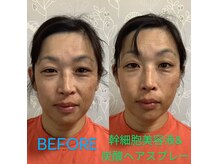 ラララン(Lalalan)の雰囲気（施術前に首と頭につけるだけ！硬くなった表皮を緩めてから施術♪）