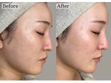 あすはれ/透明感UP!ふっくらもちもち肌へ