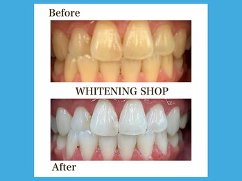 ホワイトニングショップ 福岡春日店/歯が変われば人生が変わる！
