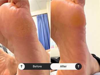 パッソ(Passo)/タコやウオノメも綺麗に改善