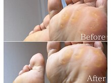 カシェット 広島店(Cachette)/40代女性☆足裏角質ケア90分