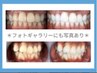 【77%OFF/来店7日前迄予約でお得】ホワイトニング24分×2回照射¥14940→3500