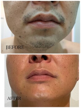 トゥルリア(TRULIA)/ハイブリッド脱毛6回目！