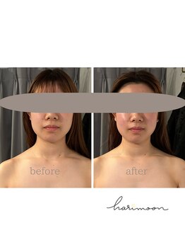 ハリムーン 仙台(harimoon)/美容鍼灸ビフォーアフター