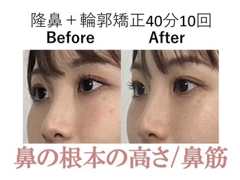 ラプリ 大阪心斎橋店(Raplit)/隆鼻＋輪郭矯正40分10回