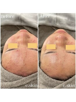 シースキン 盛岡駅前店(c.skin)/お客様ビフォーアフター