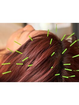 鍼灸施術を受けたい