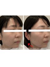 レベンディス(LEVENDIS)/レモンボトル★小顔脂肪分解