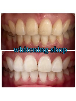 ホワイトニングショップ 豊橋店(WHITENING SHOP)/Before&After豊橋ホワイトニング