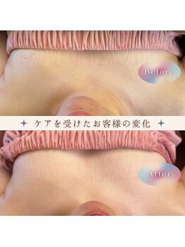 エミニナル(EMININAL)/バストケア【ビフォーアフター】