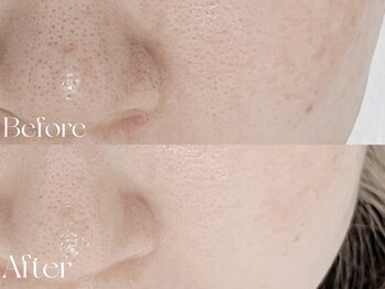 ウィハナ(wehana)/【セラピール】毛穴/黒ずみ/しみ