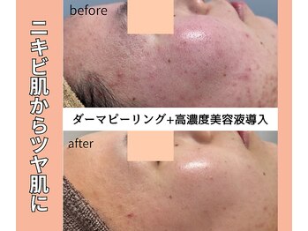 ベルミーランド 浜松天王/フェイシャルBefore→After