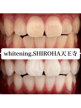 シロハ(SHIROHA)/セルフホワイトニング/天王寺