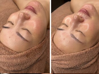 美容整体 レナトゥス 武庫之荘(Renatus)の写真/【ララピール＆グロッティプロ】敏感肌の方でも受けられる剥かないピーリングで悩み改善！憧れのツヤ肌に♪