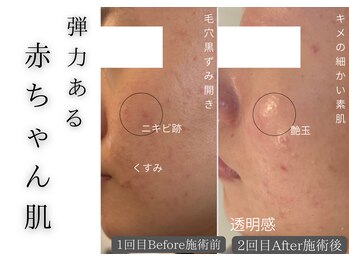 チッチ アフロディーテ(Chicchi Aphrodit)/ハーブピーリング 