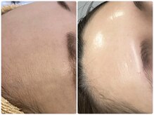 肌質改善専門【Salon da Mahina】毛穴ケア/ニキビケア/ハーブピーリング/ハーブピーリング/艶肌/藤沢