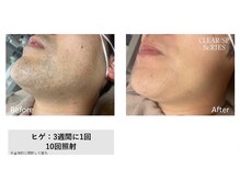 ミナ ビーズリーブル内(Mina)の雰囲気（メンズ人気NO.1のセルフヒゲ脱毛♪面倒な髭剃りともさよなら）
