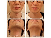 リリウム(Lilium)/脱毛｜ヒゲ脱毛