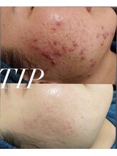 イベリス(Iberis)/ハーブピーリング/ニキビケア