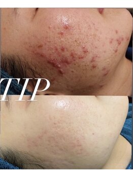 イベリス(Iberis)/ハーブピーリング/ニキビケア