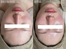 ムーム なんば店(moom)/セルマン☆30日療法