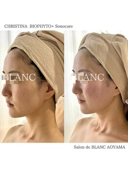 サロン ド ブラン アオヤマ(Salon de BLANC AOYAMA)/BIOPHYTO×Sonocare