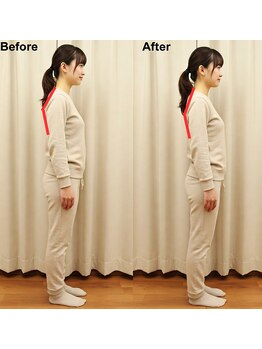 なごやの森/姿勢矯正ビフォーアフター