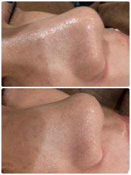 フェニーチェ 高崎(FENICE)/ハイドラフェイシャル