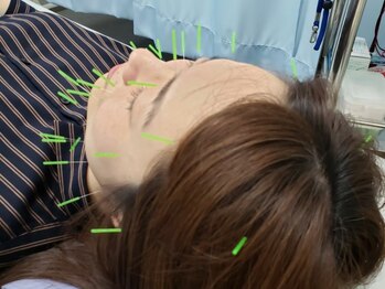 つかさ整骨院の写真/【鍼灸施術で効果を実感】ツボを鍼灸で刺激することで血行を良くし、不調を改善へ！女性特有のお悩みにも◎