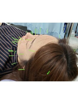 鍼灸施術を受けたい