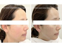 レベンディス(LEVENDIS)/レモンボトル★小顔脂肪分解