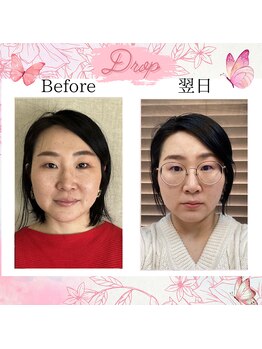 ドロップ(Drop)/頬のもたつきがスッキリ！