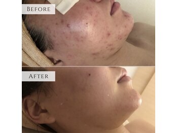 ラシェプリズ(LACHER PRISE)/ニキビケア・改善例