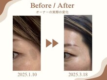 ベル(belle)の雰囲気(核酸配合フェイシャル実体験◆長年悩んでたシミがここまで変化◎)