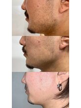 ニカ(NIKA)/ひげ脱毛＋肌ケア