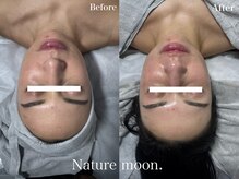 ナチュールムーン(Nature moon.)/ハーブピーリング