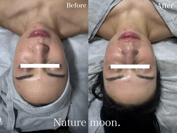 ナチュールムーン(Nature moon.)/ハーブピーリング