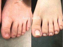アーティネイルズ(Aaty Nails)/【深爪矯正】フット