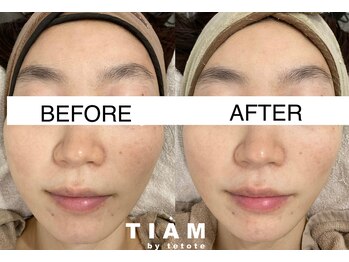 ティアム バイ テトテ 神戸三宮(TIAM by tetote)/ハーブピーリング