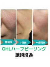 ティンクルホワイト 上尾店/ハーブピーリング施術後